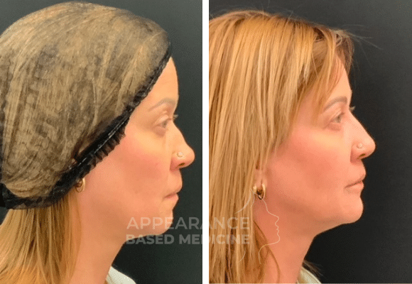 Chin Fillers Before & After