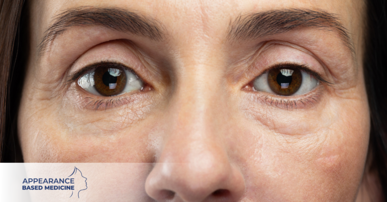 Why Do I Get Tired Eyes In Winter?