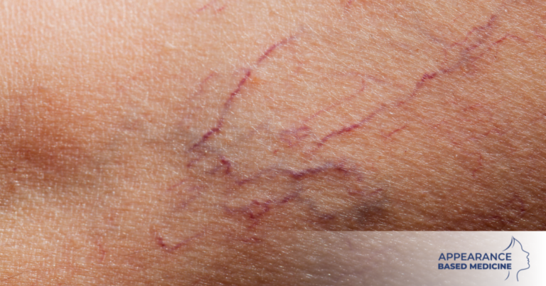 Sclerotherapy For Spider Veins