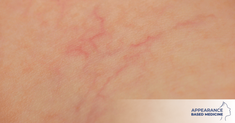 Sclerotherapy For Thread Vein Removal