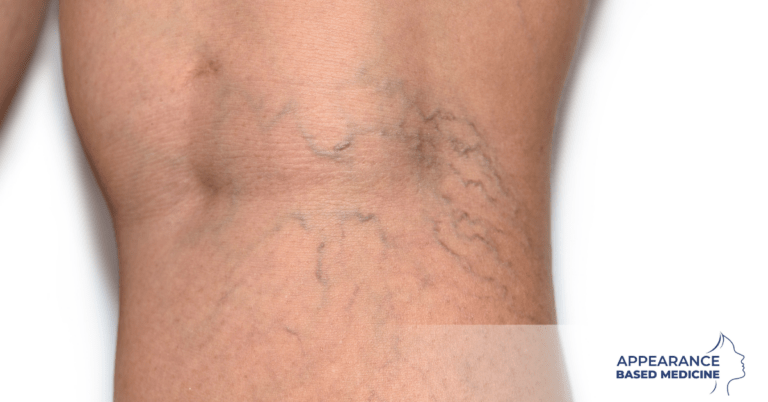 Thread Vein Removal And Why Early Treatment Will Help To Achieve The Perfect Summer Body