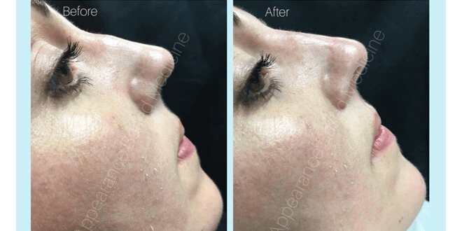 Non-Surgical Rhinoplasty… What exactly is it?