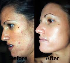 Winter Wonders: Nurturing your Dry Skin during the Festive Season 1 PP1