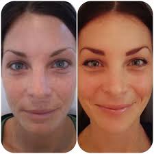 Winter Wonders: Nurturing your Dry Skin during the Festive Season 3 PP2