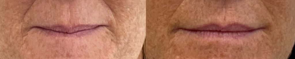 New Beginnings: Embracing 2024 with Natural Lip Enhancement 2 Lip Fillers Before & After