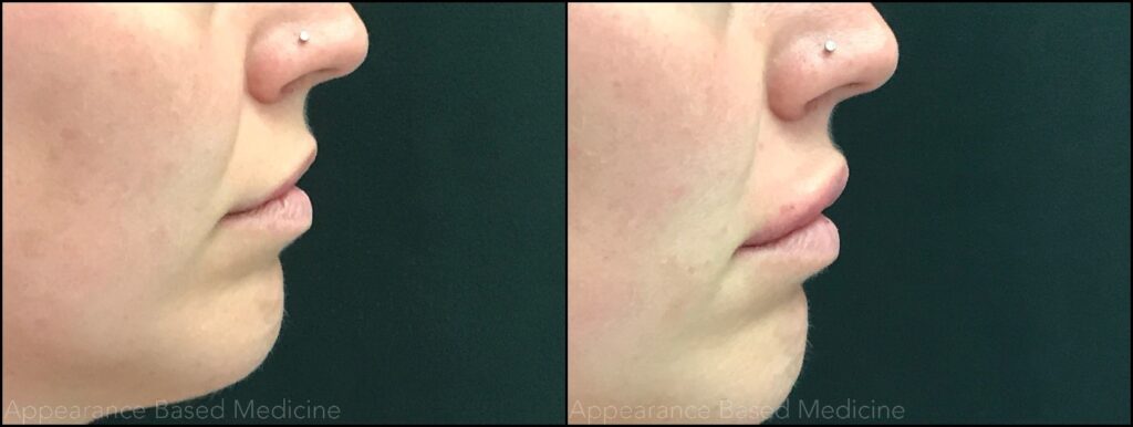 Lip Enhancements with AB Med