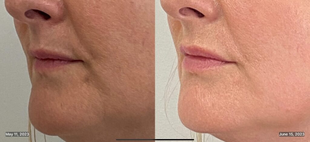 New Beginnings: Embracing 2024 with Natural Lip Enhancement 3 Lip Fillers Before & After