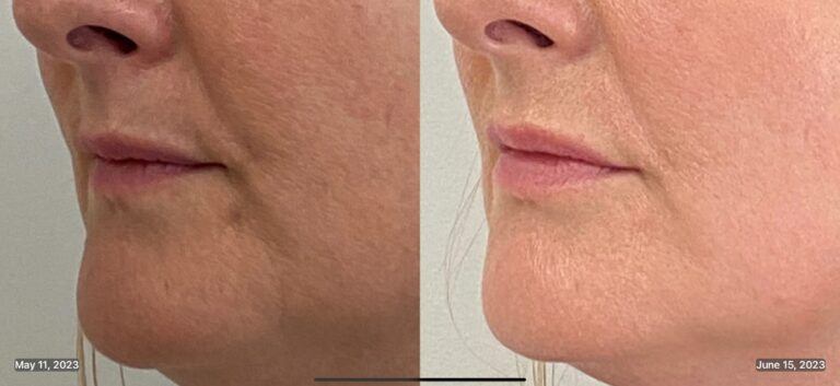 Lip Fillers with AB Med