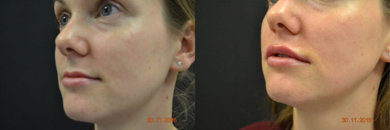 lip enhancement fillers before & after