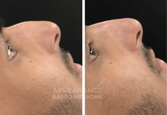 Non-surgical rhinoplasty before & after