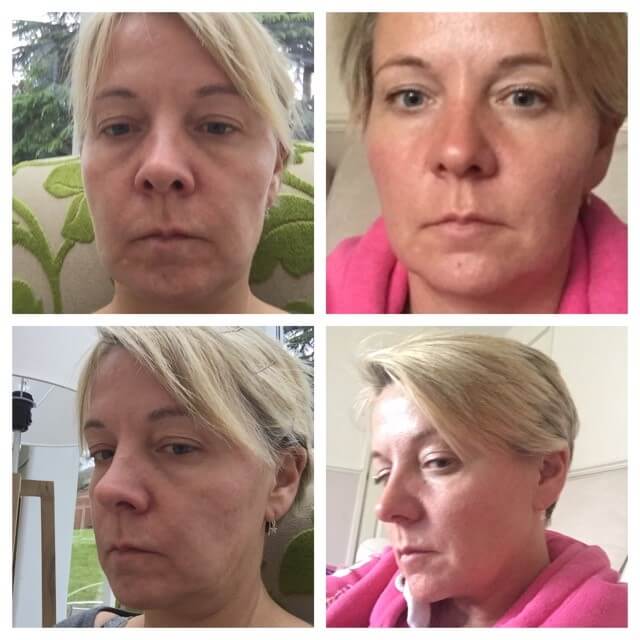cheek-filler-results (Photos taken by patient at home)