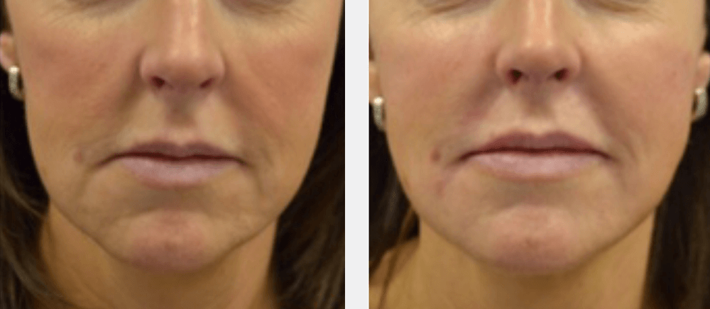 cheeks-before-after cheeks before after